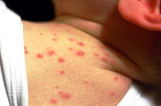 Për një muaj 17 raste të fruthit, IKSHPK apel prindërve: Vaksinoni fëmijët